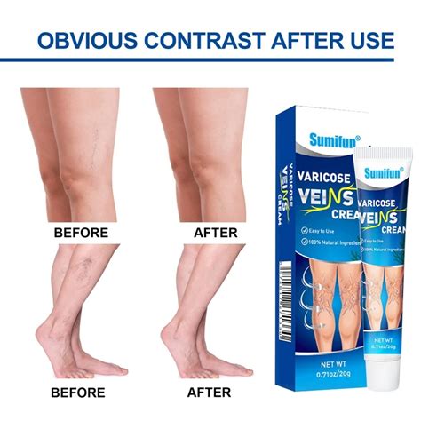 Varicose Veins Treatment Ointment Cream Relief Veins Pain Vasculitis Phlebitis Spider Leg Health