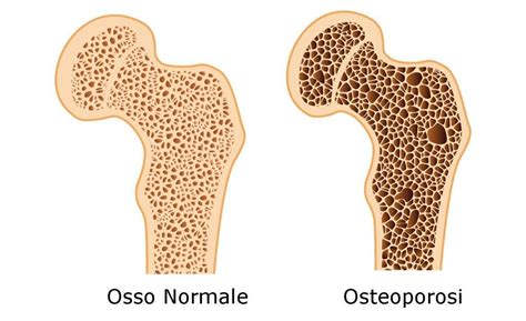 Osteoporosi Meglio Prevenire Che Curare