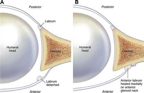 The Flying Swan Technique A Novel Method For Anterior Labral Repair