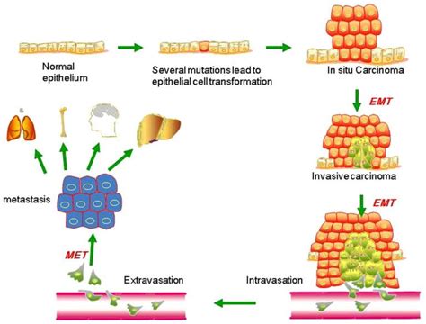 Pathophysiology Breast Cancer Case Study