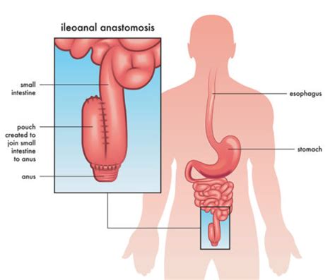 Ulcerative Colitis UC Surgery UNC REX Colorectal Surgery