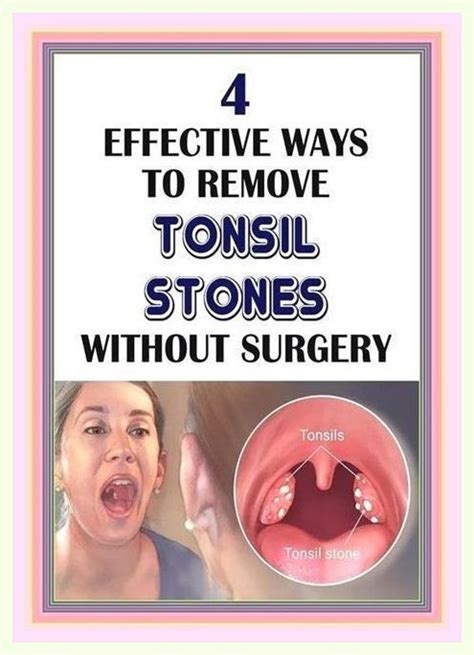 Tonsils Wide Varieties Gbu Hamovniki Ru