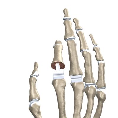 Artificial Joint Replacement of the Finger - eOrthopod.com