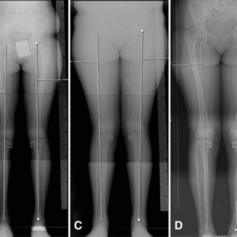 A A Patient With Genu Valgum Treated With Four Eight Plates B