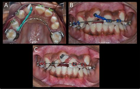 Orthodontic Correction Of Maxillary Canine Lateral Incisor