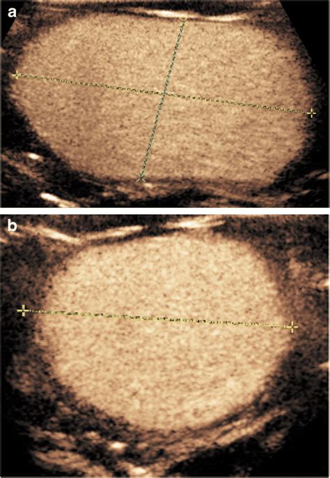 Measuring Bladder Capacity During Contrast Enhanced Voiding