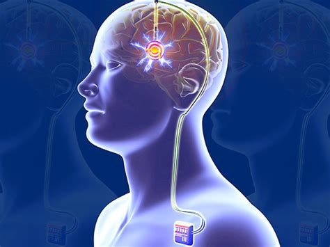 Transcranial Stimulation Therapy Improving The Brain S Capacity