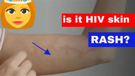 What Does Hiv Rash Look Like How To Tell Hiv Rash Youtube