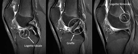 La Rupture Du Ligament Crois Ant Rieur De L Enfant