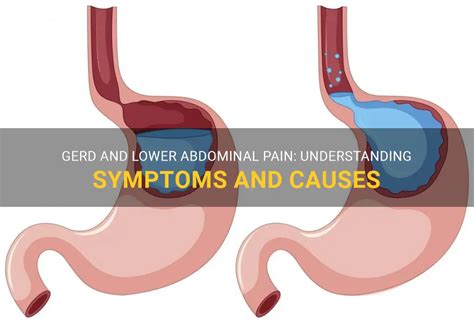 Gerd And Lower Abdominal Pain Understanding Symptoms And Causes Medshun