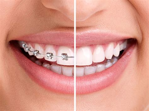 Clear Braces Acecare Orthodontics