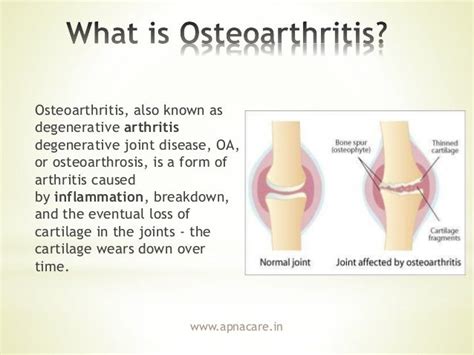 5 Tips To Prevent Osteoarthritis