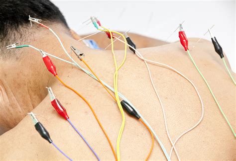 Acupuncture With Electric Stimulation Acupuncture Physical Therapy