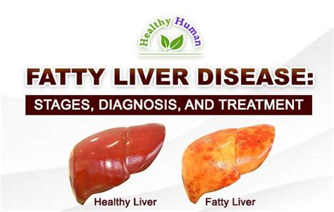 Fatty Liver Disease Stages Diagnosis And Treatment