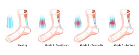 Achilles Tendon Rupture: Empower Your Recovery!