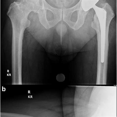 A Anteroposterior Ap Pelvis And B Cross Table Lateral Radiographs