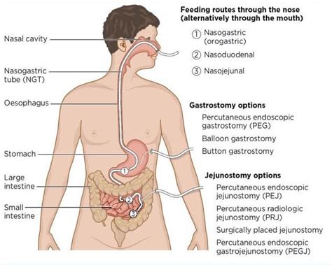 PEG Tube Placement Procedure|Nursing Care&Health Education, 43% OFF