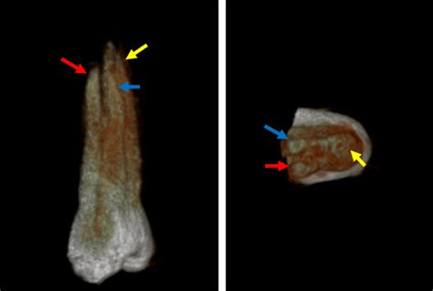 Premolar superior con tres raíces Dento Metric Radiología Dental