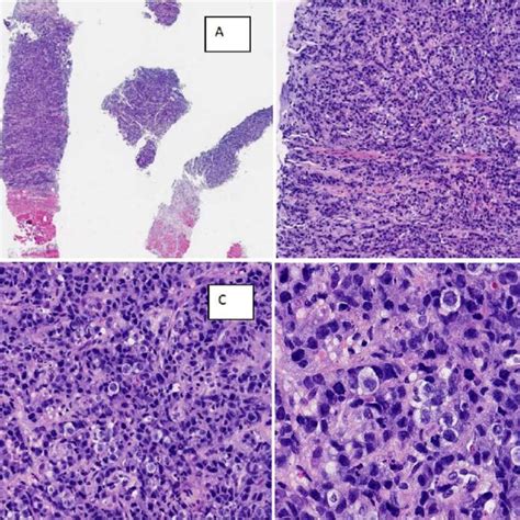 A A Small Number Of Tumor Tissue Biopsies Were Obtained With More