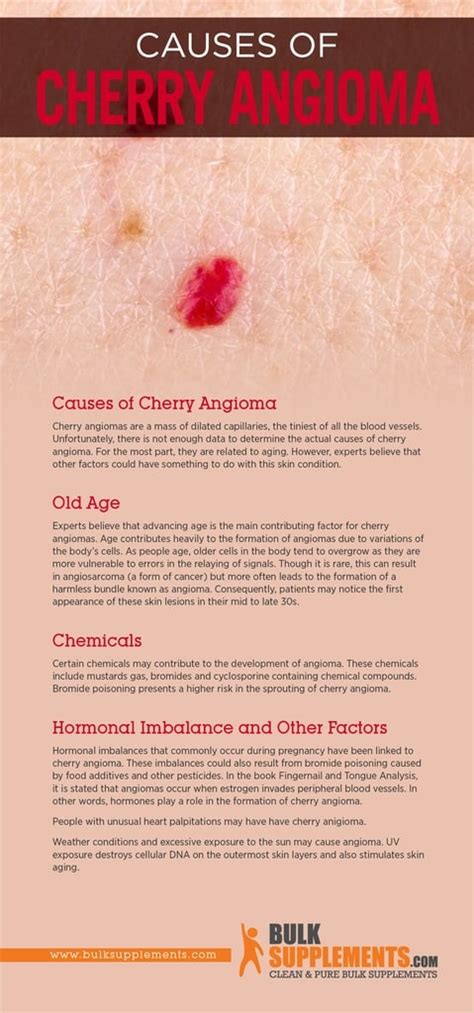 Cherry Angioma: Characteristics, Causes & Treatment