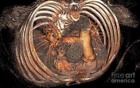 Pulmonary Artery Photograph By Vsevolod Zviryk Science Photo Library