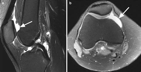 Synovium and Capsule | Radiology Key