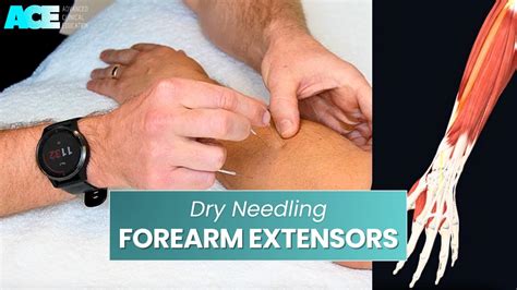 Dry Needling Forearm Extensors Youtube