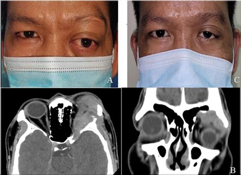 Adenoid Cystic Carcinoma Of The Lacrimal Gland In A 36 Year Old Male