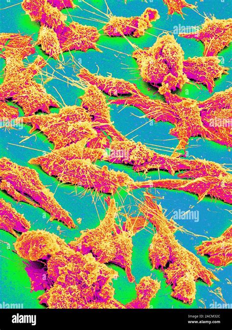 Cancer Cells Coloured Scanning Electron Micrograph Sem Cancerous