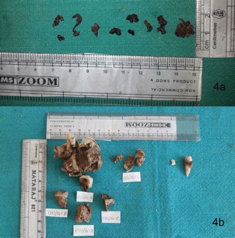 Macroscopic Examination Of Excisional Biopsy From Maxilla A Mandible