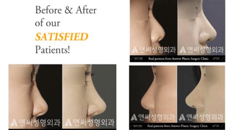 Plastic Surgery Before And After Nose Korean