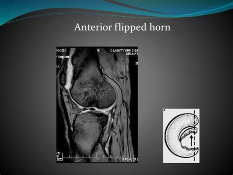 Mri Of Knee