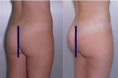 Lipofilling de fesses à Paris ou Brazilian Butt Lift Docteur Frédéric