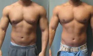 Gynecomastia Surgery In Surat Id