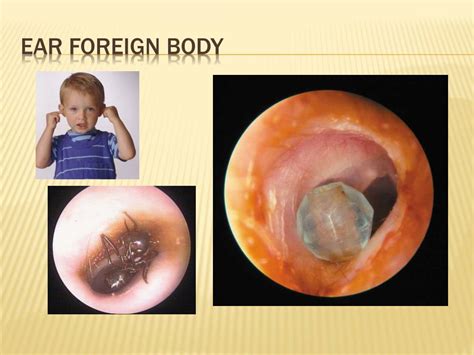 Ppt Otorhinolaryngology Disorders Of The Ear Nose And Throat