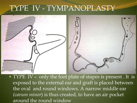 Tympanoplasty; Indications, types, anesthesia, surgical procedure.