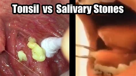 Tonsil Stone Vs Salivary Stone What S The Difference Youtube