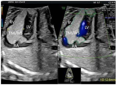 Successful Prenatal Treatment Of Cardiac Rhabdomyoma In A Fetus With Tuberous Sclerosis