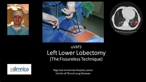 Left Lower Lobectomy The Fissureless Technique Uvats Youtube