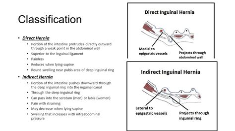 Inguinal Hesselbachs Triangle Borders Direct Hernia Teachmeanatomy