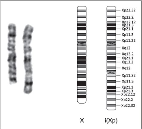 Figure 1 From Pseudoisodicentric Xp Chromosome 46xpsu Idicxq211 And Its Effect On