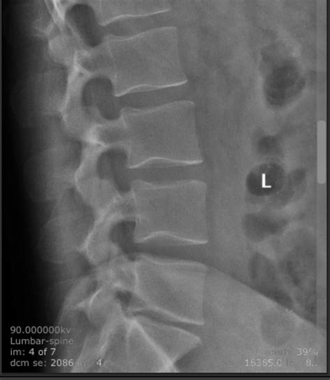 My Spine Showing Mild Disc Degeneration At My L5s1 R Xrayporn