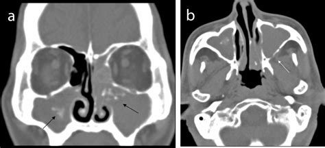 Coexistence Of Extramedullary Plasmacytoma And Fungus Balls In The