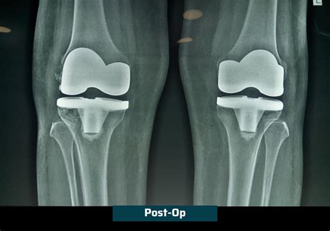 Primary Total Knee Replacement Surgery Dr Rachit Sheth