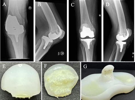 Tibial Polyethylene Post Fractures At Ten Years In A Bicruciate