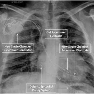 Stages of the procedure. (A) Venogram of SVC occlusion. (B) Venoplasty ...