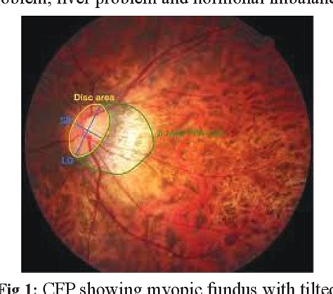 Figure 1 From Congenital Rubella Syndrome A Case Report With Clinical Manifestation And