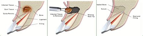 Root End Surgery - Victoriapark Dental - Dentist London