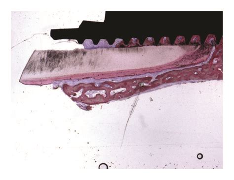 Trabecular Mature Bone At The Interface Of The Implant Was Observed