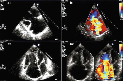 4 A1 A2 Two Dimensional Echocardiographic Image In A Patient With